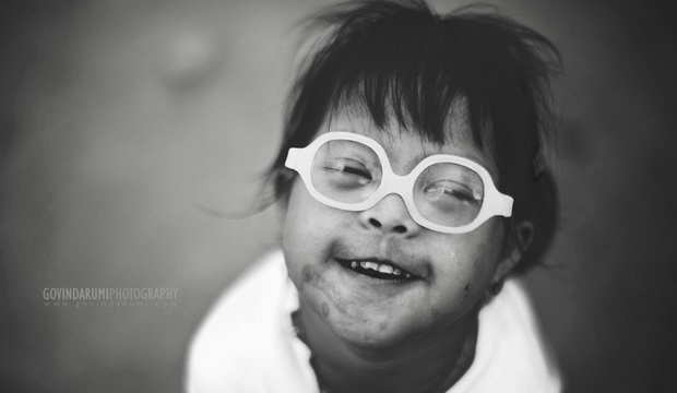 Дети с синдромом Дауна сложный выбор